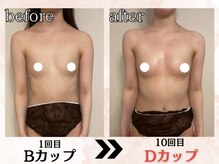 プリマ(prima)/バストアップ症例