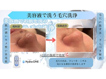 ティー(T)/ハイドラフェイシャル