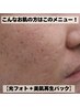 【ニキビ後の凸凹や跡を改善したい】ヒゲ脱毛(顔)+再生パック ¥5,000