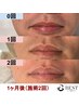 【2回目以降】髭(鼻下/口下/アゴ/アゴ下首/両ほほ/両もみあげ)脱毛　¥3,000