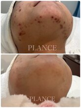 プランス 渋谷(PLANCE)/毛穴/ハーブ/ニキビケア