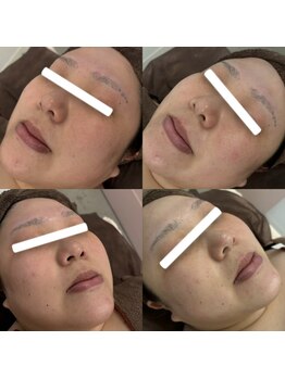 ホロニック ベルサンテ(Holonic Belle Sante)/くすみ/開き毛穴/肌ツヤ