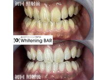 ホワイトニングバー 福島店/初回ビフォーアフターをご紹介