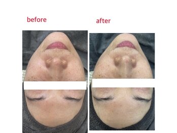 サロンドティアラ(Salon de Tiara)/シミケア(フォト)