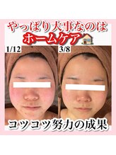 ホワイトアクア 天王寺本店(WHITE AQUA)/ハーブピーリング/天王寺/乾燥