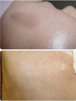 ムーンリズム(Moonlism)/【TIPハーブ症例】跡