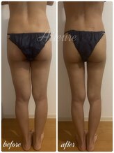 エルール トータルビューティ(Aileure total beauty)/術後ケア　太もも