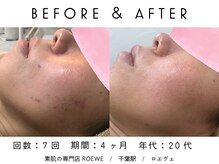 ロエヴェ(ROEWE)/ニキビ改善・毛穴ケア・肌質改善