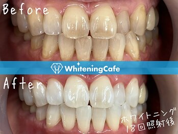 ホワイトニングカフェ 柏店/施術写真 50代女性 パート