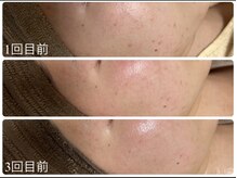 エル(Elle)/跡 毛穴