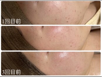 エル(Elle)/跡 毛穴