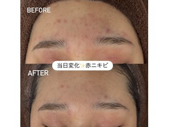 テンニック(10nick)/当日変化/赤ニキビ