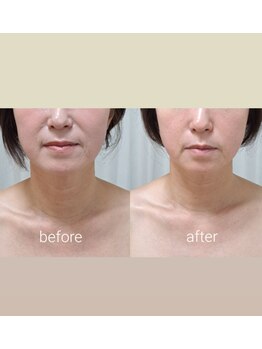 ネマウム(nemaum)/エイジングケアエステ