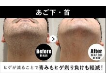 RBL イオンモール沖縄ライカム店/メンズ脱毛/ヒゲ脱毛1回目剃毛後