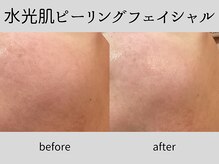 マーベル(MaaBelle)/40代/水光肌ピーリング