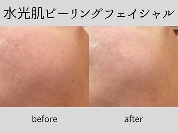 マーベル(MaaBelle)/40代/水光肌ピーリング