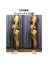 ビハダエステ 町田店(BIHADAエステ)/【B/A】30代後半ハイパーナイフ