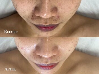 イースト(EAST)/プラズマシャワー4回