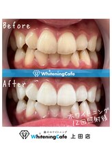 ホワイトニングカフェ 上田店/ホワイトニングビフォーアフター