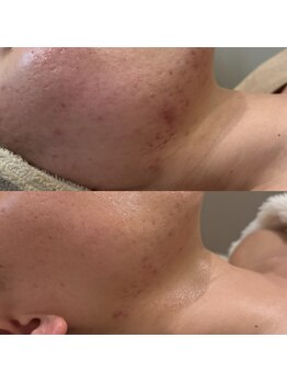 ジャストミービューティー(Just Me Beauty)/肌質改善/毛穴ケア/ニキビケア