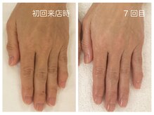 キレイテ 上野店/50代/7回目【ハンドケア上野】