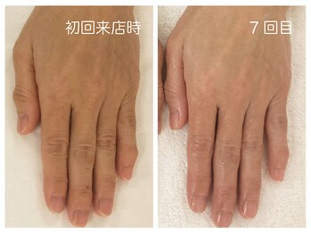 キレイテ 上野店/50代/7回目【ハンドケア上野】