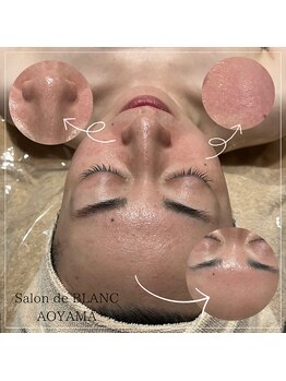 サロン ド ブラン アオヤマ(Salon de BLANC AOYAMA)/CHRISTINAハーブピーリング