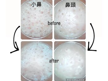 フェローズリンパケア(FELLOWS)/毛穴メニュー