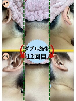 ディスイズミー シュガーリング(This is me Sugaring)/【ダブル】１番似合う形を提案