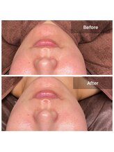 プライベートサロン アール(R)/カーボキシー×バンテージ