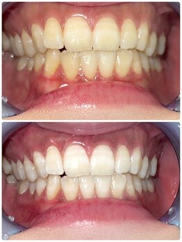 エクシアホワイトニング 札幌中島公園店/Before After［ホワイトニング］