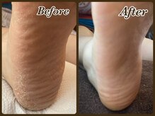 ビューティースパ(Beauty-Spa)/【硬く厚い足裏の角質除去】
