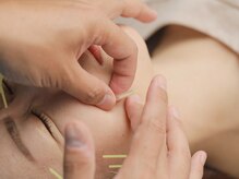 オカモト鍼灸整骨院/お肌のお悩みにおススメ！