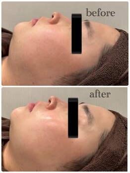 ツール(TOOL)/ハーブピーリング