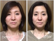 アップル マリー 江別/■小顔矯正