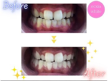 エクシアホワイトニング 新白河店/ホワイトニングビフォーアフター