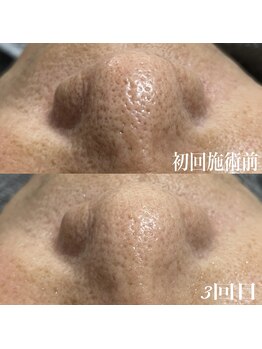 コリー(Kolly)/鼻集中コース