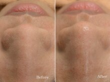 ベル(Bell)/毛穴洗浄