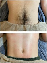 レピ(RePi)/Wax 脱毛メンズ