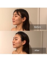 サロンウム(Salon umu)/造顔小顔1回の施術効果
