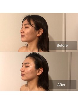 サロンウム(Salon umu)/造顔小顔1回の施術効果