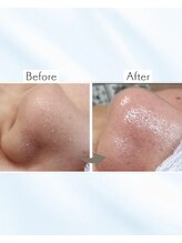 サロン モウ(mou。)/毛穴黒ずみ