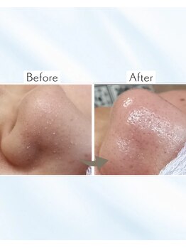 サロン モウ(mou。)/毛穴黒ずみ