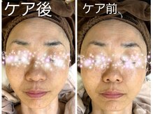 たいち接骨院/筋膜＋エクスポレーション