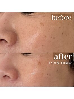 スイ(Sui)/美肌光フェイシャル　光脱毛