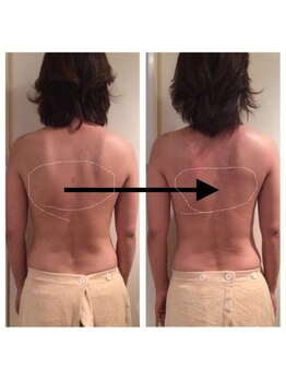 ブルームーン コルギアンドエステティック(Blue moon)/上半身コルギbefore after