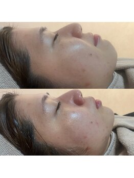 ビーマジック(Be Magic)/毛穴/毛穴洗浄/乾燥/肌荒れ