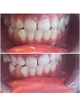 エクシアホワイトニング 代々木店/ホワイトニングビフォーアフター