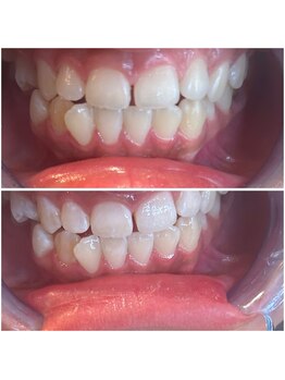 エクシアホワイトニング 代々木店/ホワイトニングビフォーアフター