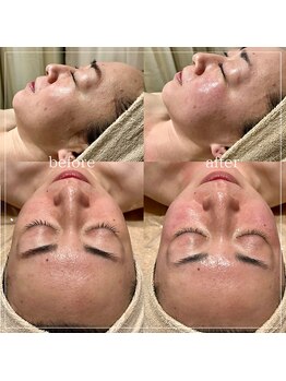 サロン ド ブラン アオヤマ(Salon de BLANC AOYAMA)/CHRISTINAハーブピーリング